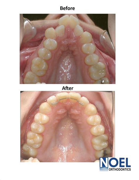 Class Ii Malocclusion Treatment Adults Terrell Chisholm