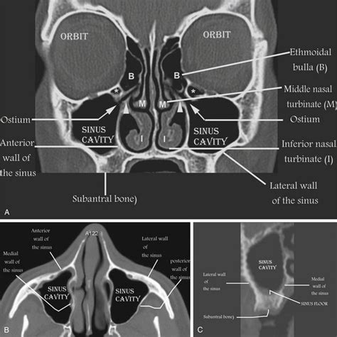 Nasal Bone Anatomy Ct Imaging Maxillofacial Trauma Radiology Key