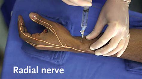 Peripheral Nerve Blocks For Hand Procedures Nejm