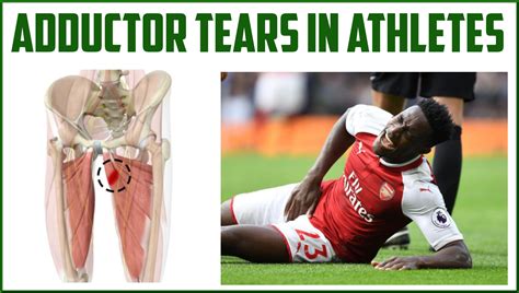 Adductor Tears In Athletes Sports Medicine Review