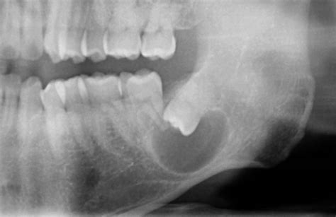 Benign Jaw Cysts And Tumours Association Oms Singapore