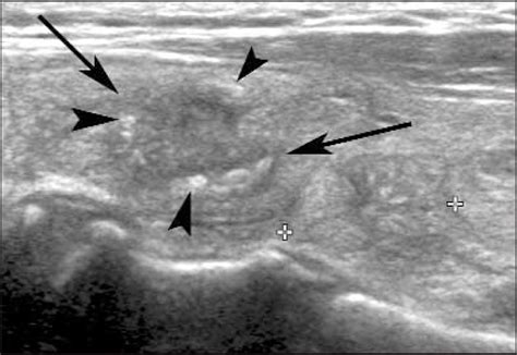 Peripheral Calcification In Thyroid Nodules Yoon 2007 Journal Of