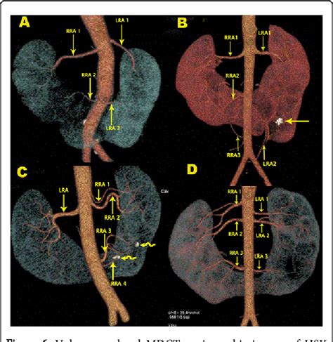 Figure 5 From Renal Fusion Anomalies A Review Of Surgical Anatomy