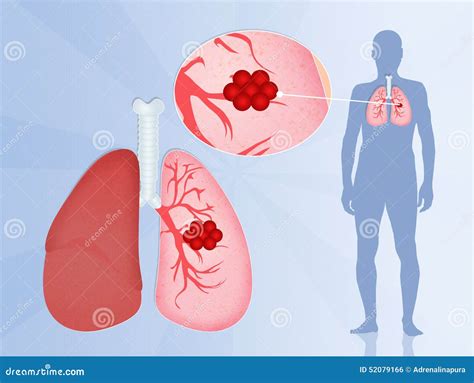 Lungs Cancer Stock Illustration Illustration Of Human 52079166