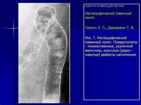Диета при неспецифическом Пищеварительная система. Неспецифический язвенный колит. + | Портал Пищеварительная система. Неспецифический язвенный колит. + | Портал Диета при неспецифическом
