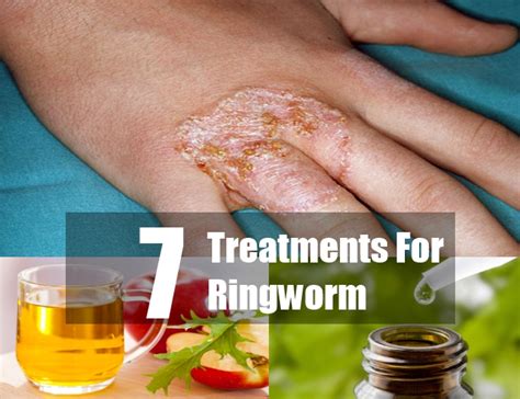 7 Amazing Herbal Remedies To Treat Ringworm Naturally
