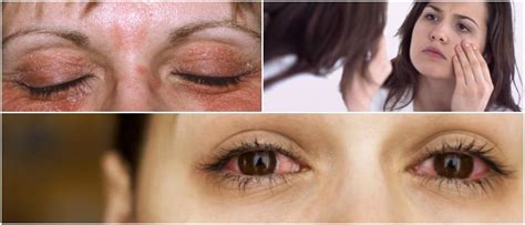 Psoriasis On The Eyelid Causes Symptoms Complications And Treatment