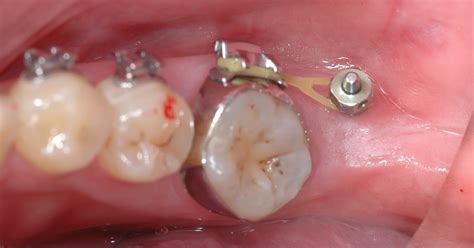Dental Implant Professional Orthodontic Miniscrew For Molar Distalization