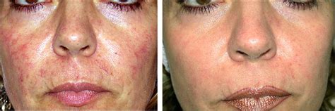 Facial Redness Laser Treatment Ipl London Sw1