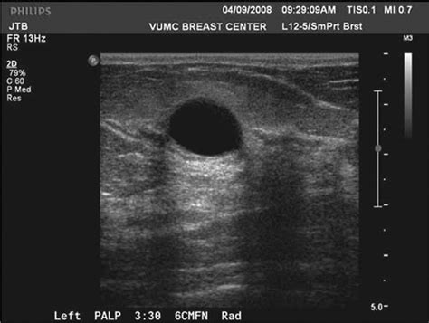 The Sonographic Findings And Differing Clinical Implications Of Simple