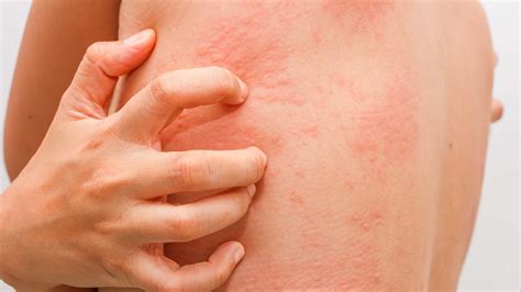 Though zinc deficiency in the united states is not widespread, some people are at risk, including pregnant women below are 10 of the most common signs and symptoms of zinc deficiency. 11 Signs You May Have a Zinc Deficiency