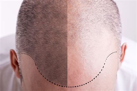 How Does A Hair Transplant Work MyMediTravel Knowledge
