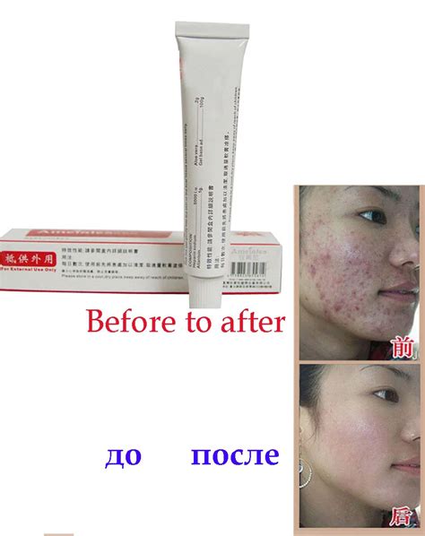 15g Women Freckle Dark Spots Removal Cream Skin Care Acne Spot And Sun Spot Remove Face Speckle
