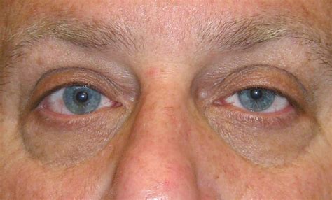 Maybe you would like to learn more about one of these? Cosmetic and Functional Eyelid Surgery | Nissman Eye Associates