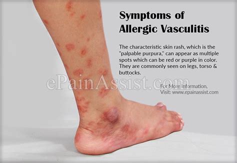 Symptoms Of Hypersensitivity Vasculitis Or Allergic Vasculitis