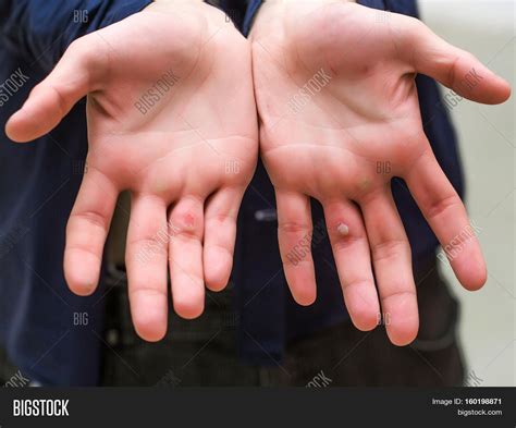 Male Hands Palms Painful Unhealthy Image And Photo Bigstock