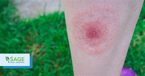 What You Need To Know About Treating Tick Bites