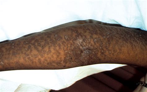 Western Blotting As The Confirmatory Test For Syphilis In A Patient With Systemic Lupus