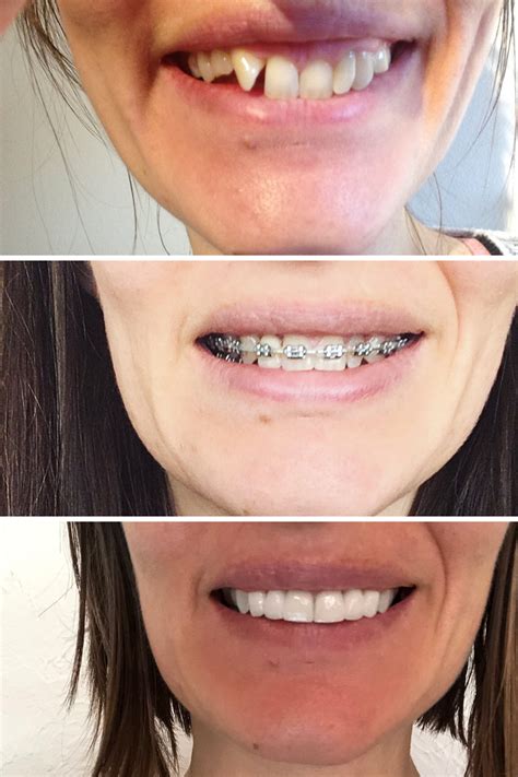 Pin On Adult Braces Before After Cosmetic Dentistry