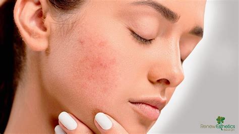 6 Steps For Facial Redness Solution Renew Esthetics