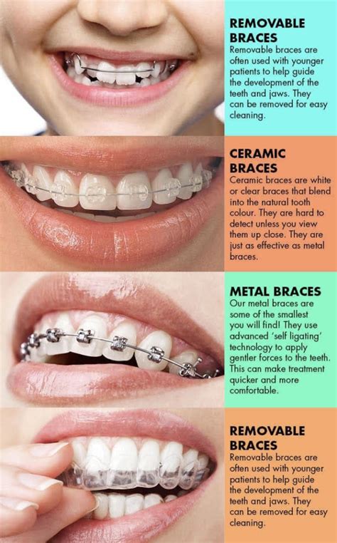 Different Types Of Braces And Their Cost In South Africa Greater Good Sa