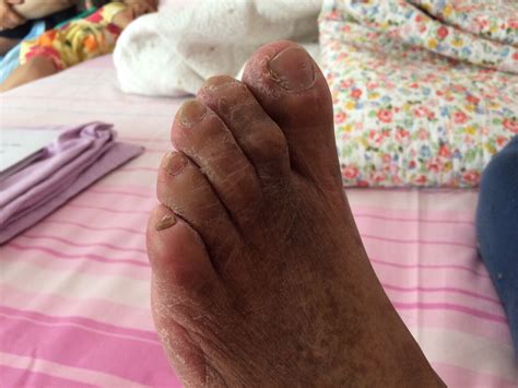 Diabetic Feet Neuropathy Ayurvedic Treatment At Royal Ayurveda