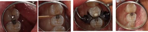 Two Methods Of Indirect Pulp Capping For Removing Caries Spear Education