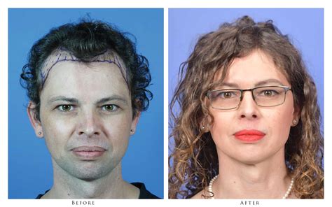 Transgender Before And After Photos Gallery Portland Oregon Gabel Center