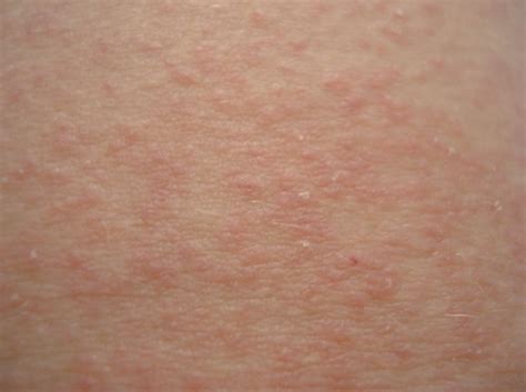 Sweat Rash Pictures Causes And How To Get Rid Of It