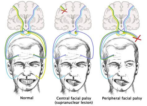 Peripheral Facial Palsy Telegraph