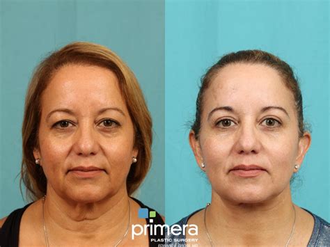 Mini Facelift Before And After Pictures Case 771 Orlando Florida Primera Plastic Surgery