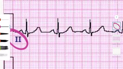 ECG Derivaciones y caras Ciclo cardiaco básico YouTube