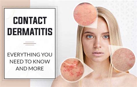 Contact Dermatitis Causes Symptoms And Treatment Options