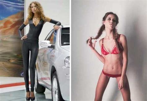 30 Shocking Pics Of Anorexic Girls KLYKER