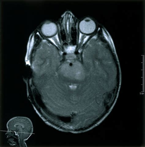 Brain Stem Tumor Mri