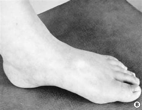 Swelling And Pitting Edema Of Both Hands A And The Dorsum Of The Feet