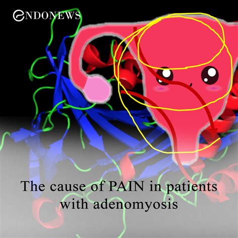 The Cause Of Pain In Patients With Adenomyosis Endonews
