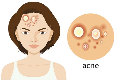 Are Acne And Pimple Is The Same Thing Reliablerxpharmacy Blog