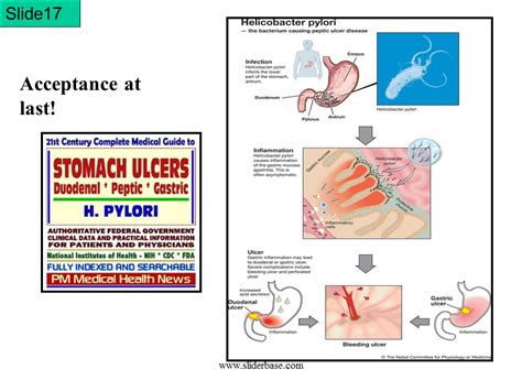 Bacteria Helicobacter Pylori Ulcers Presentation Health And Disease