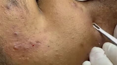 Blackheads And Milia Big Cystic Acne Blackheads Extraction Whiteheads