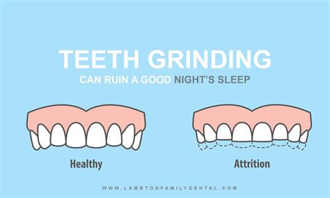 The Nightly Grind Teeth Grinding Causes Risks Cures For Bruxism