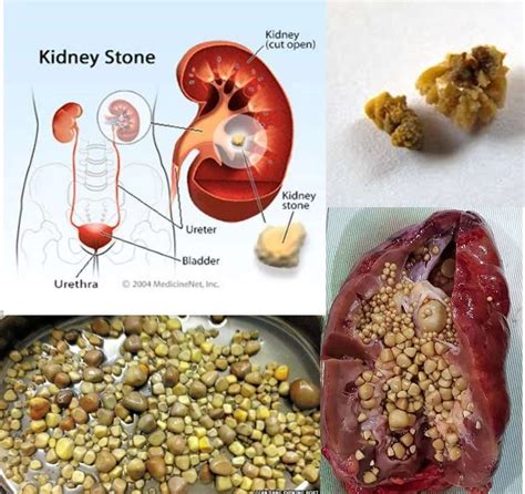 Who Is More Likely To Get Kidney Stones