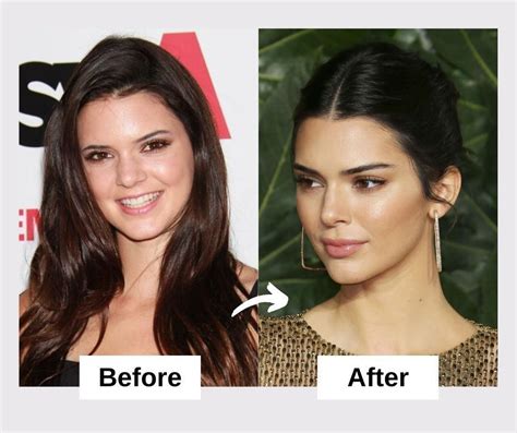Kendall And Kylie Jenner Plastic Surgery Telegraph