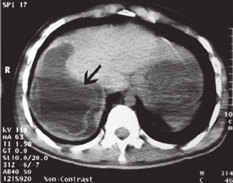 Hydatid Cyst With Collapsed Parasitic Membranes Unenhanced Ct Scan Of