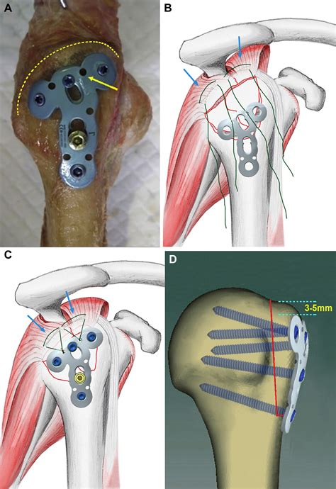 A New Low Profile Anatomic Locking Plate For Fixation Of Comminuted