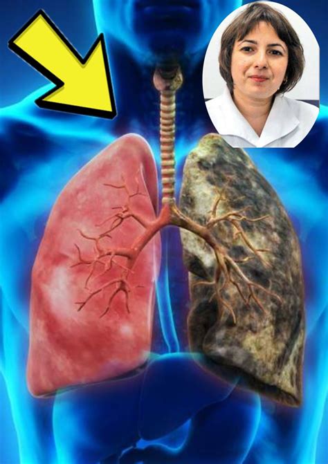 Cand Este Tusea Un Semn Al Cancerului Pulmonar Cancer Pulmonar