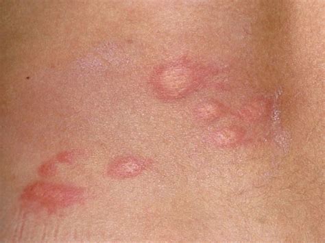 Visual Guide To Childrens Rashes And Skin Conditions Urticaria