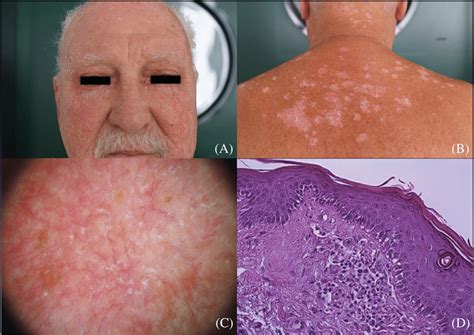 Diffuse Facial Erythema With Bilateral Mild Ectropion And Severe
