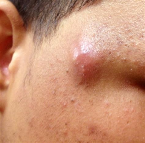 Sebaceous Cyst Causes Symptoms Treatment And Pictures Hubpages