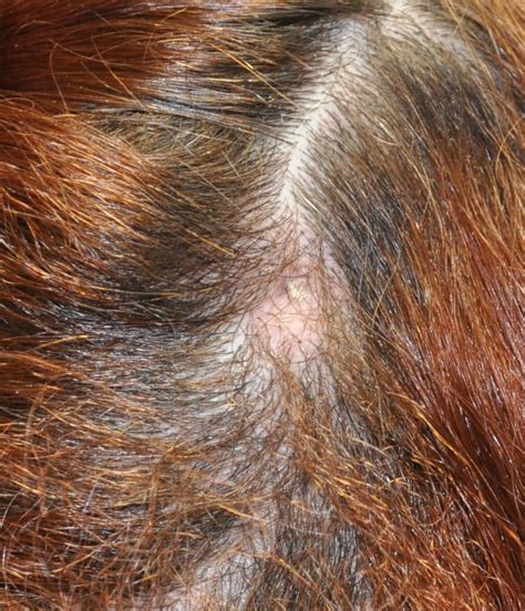 Cisti Sebacee: tecnica di rimozione mini invasiva - Metodo ...